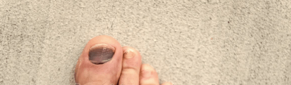 ČRNI NOHTI IN PRSTI BREZ&nbsp;NOHTOV