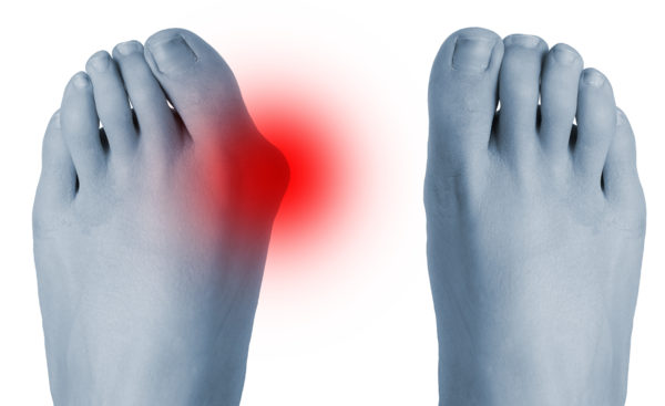 HALLUX VALGUS (izbočeni nožni palec) IN&nbsp;TEK